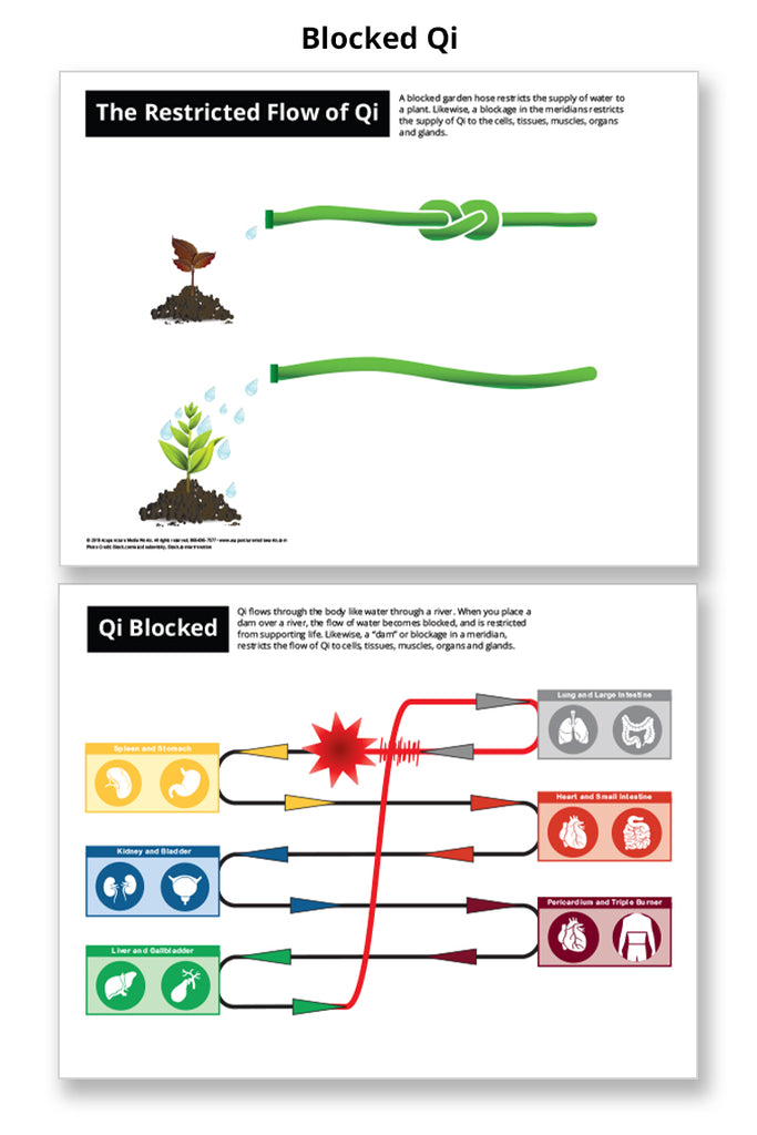 Blocked Qi - Acupuncture Laminated Chart